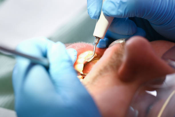 Best Knocked-Out Tooth (Avulsed Tooth) Treatment in Okawvle, IL